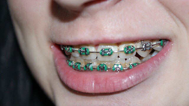 colored braces