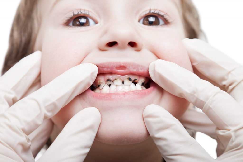 Gum Disease In Children Macon County Child Advocacy Center